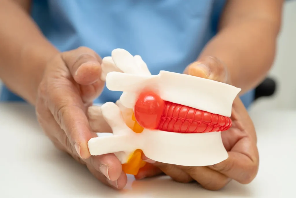 Disc injury treatment Sanford NC Herniated disc chiropractic care Spinal decompression therapy Chiropractor adjusting patient spine Back pain relief techniques Sciatica nerve pain treatment Neck and back disc alignment Chiropractic exercises for disc injuries Gentle spinal adjustment therapy Non-surgical disc pain relief